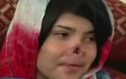 Afganistan. O tânără a primit un nas nou, după ce soţul i l-a tăiat pe cel natural (VIDEO)