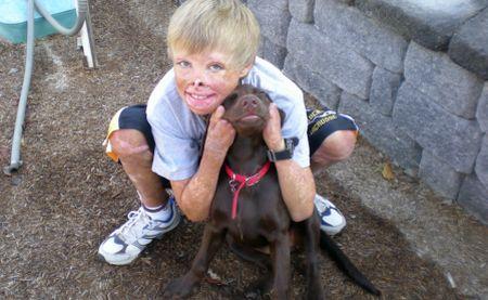 Un băiat român mutilat într-un incendiu, îngrijit exemplar în SUA 89936