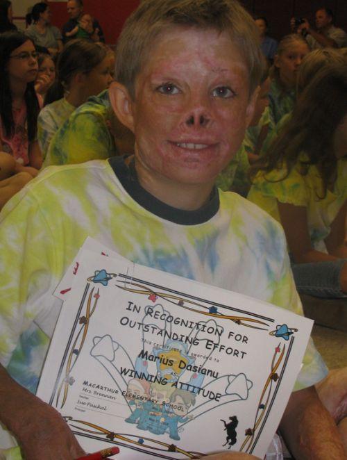 Un băiat român mutilat într-un incendiu, îngrijit exemplar în SUA 89940