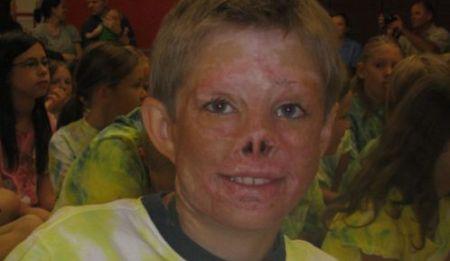 Un băiat român mutilat într-un incendiu, îngrijit exemplar în SUA 89943