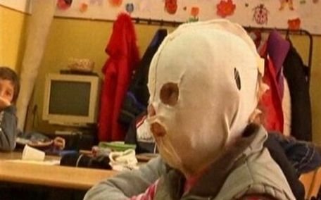 O fetiţă de 10 ani cu faţa arsă trebuie să poarte o mască de plastic tot timpul