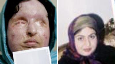 Justiţie iraniană: O femeie orbită de soţ cu acid are dreptul la răzbunare
