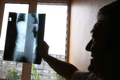 Peste 72.000 de români suferă de boala Parkinson