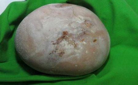 Piatră de aproape un kilogram, scoasă din vezica urinară a unui bărbat din Dolj
