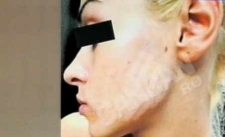 Şocant! Tânără mutilată la cosmetică, din cauza unui tratament anti-acnee