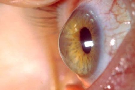 Keratoconul - boala care distruge corneea: Apare mai des la cei cu lentile contact şi alergii oculare