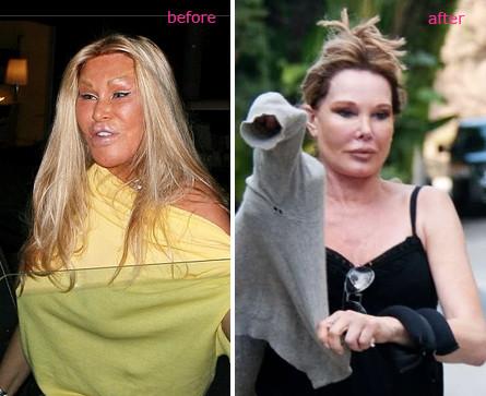 Rişti să orbeşti. Vezi cum arată vedetele înainte şi după dezastrul bisturiului. GALERIE FOTO 109367