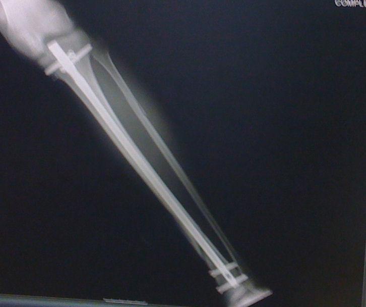 Un medic din Vaslui, acuzat că a uitat mai multe pansamente în piciorul unui tânăr