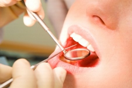 Studiu: Detartrajul regulat al dinţilor reduce riscul de atacuri cardiace şi cerebrale