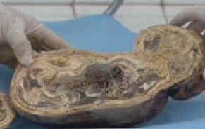 A dat naştere unei MUMII! Vezi un top cu cele mai şocante cazuri medicale 116219