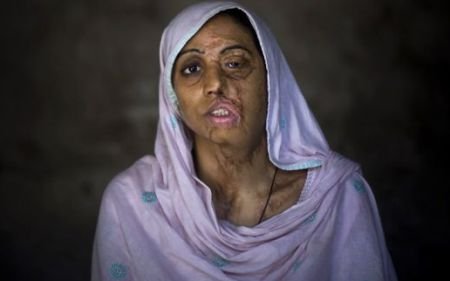 O familie din Afganistan, mutilată cu acid. Fiica cea mare a refuzat să se căsătorească cu un barbat