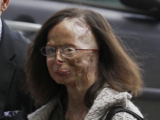 A ajuns să arate ca o MUMIE, după ce amantul i-a aruncat cu vitriol în faţă. Aceste imagini te vor ŞOCA 136115