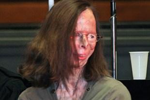 A ajuns să arate ca o MUMIE, după ce amantul i-a aruncat cu vitriol în faţă. Aceste imagini te vor ŞOCA 136118