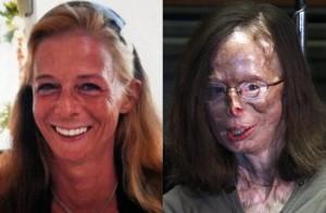 A ajuns să arate ca o MUMIE, după ce amantul i-a aruncat cu vitriol în faţă. Aceste imagini te vor ŞOCA 136119