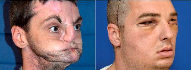 Când Dumnezeu lucrează cu mâinile doctorilor. Cum arată un american care a suferit un transplant de faţă 138891