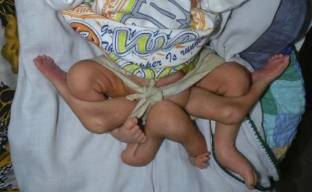 Un copil s-a născut cu şase picioare. Medicii pakistanezi încearcă să-i salveze viaţa