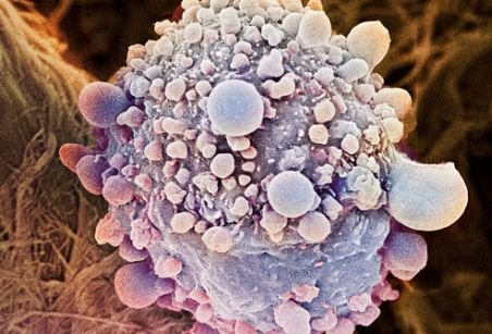 Extinderea cancerului pancreatic poate fi stopată: O genă inactivă, cheia întregului proces