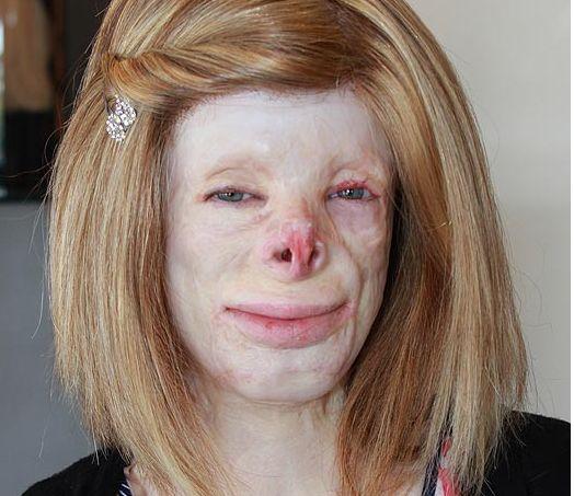 &quot;I-am nenorocit viaţa copilei mele! Pompierii au crezut că este o păpusă arsă&quot;. Povestea şocantă a copilei cu chipul topit 151656