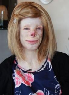 &quot;I-am nenorocit viaţa copilei mele! Pompierii au crezut că este o păpusă arsă&quot;. Povestea şocantă a copilei cu chipul topit 151659