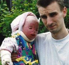 &quot;I-am nenorocit viaţa copilei mele! Pompierii au crezut că este o păpusă arsă&quot;. Povestea şocantă a copilei cu chipul topit 151661