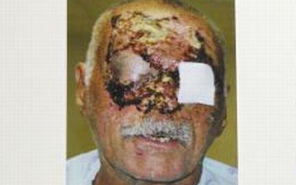 &quot;Pur şi simplu m-a sfâşiat. M-a muşcat de faţă. Mi-a scos ochii&quot;. Interviu cu victima canibalului din Florida 162491