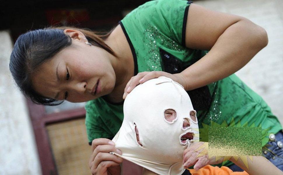 &quot;Viaţa este ca un zbor de fluturi&quot;. Imaginile care spun durerea copilului fără chip 163643