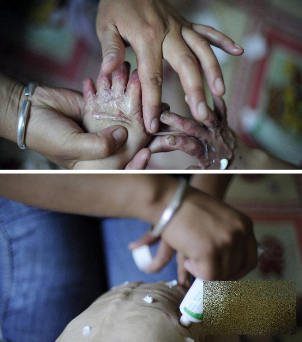 &quot;Viaţa este ca un zbor de fluturi&quot;. Imaginile care spun durerea copilului fără chip 163646