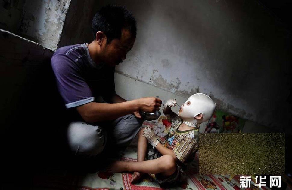 &quot;Viaţa este ca un zbor de fluturi&quot;. Imaginile care spun durerea copilului fără chip 163649