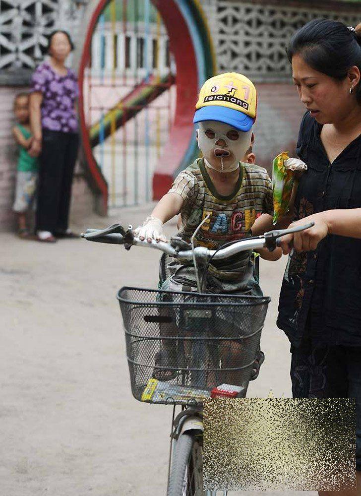 &quot;Viaţa este ca un zbor de fluturi&quot;. Imaginile care spun durerea copilului fără chip 163651