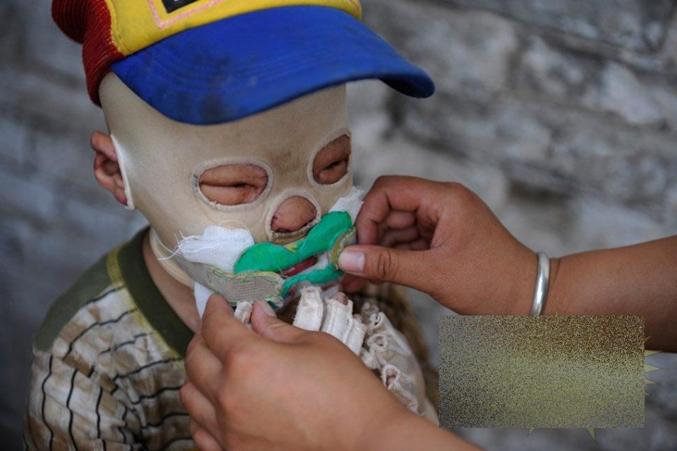 &quot;Viaţa este ca un zbor de fluturi&quot;. Imaginile care spun durerea copilului fără chip 163654