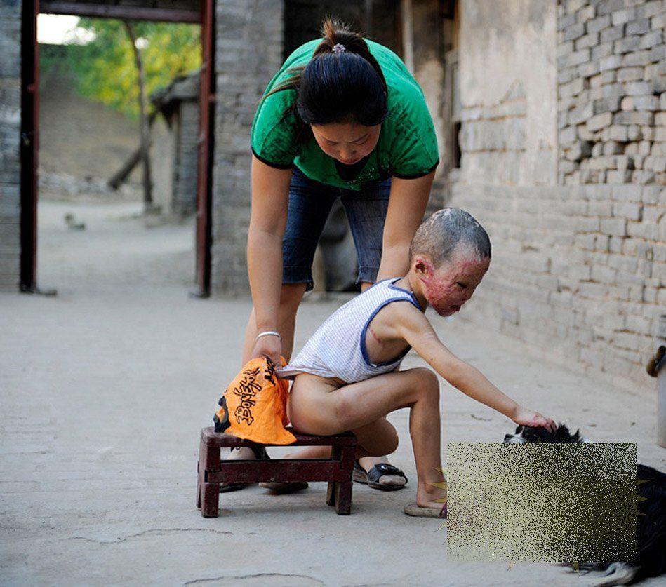 &quot;Viaţa este ca un zbor de fluturi&quot;. Imaginile care spun durerea copilului fără chip 163655