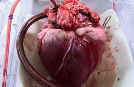 &quot;Nu-mi mai bate inima şi nu mai am nici puls&quot;. Omul care trăieşte de patru luni fără inimă 165568