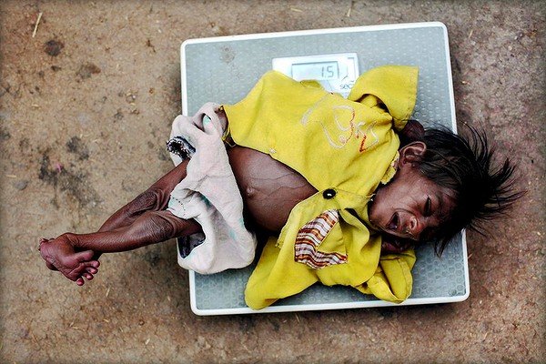  „Este o ruşine naţională”. Ţara foamei în care 40% dintre copii sunt malnutriţi