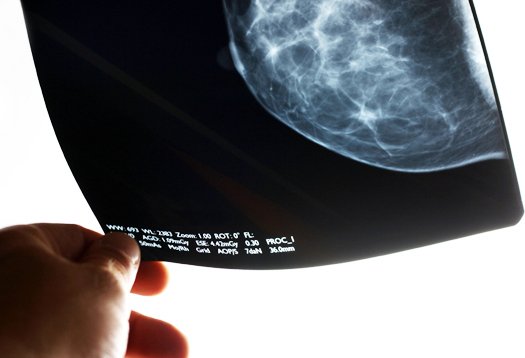 Acest test a trimis milioane de femei să se trateze împotriva cancerului de sân, deşi era greşit