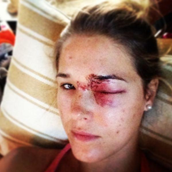 Aşa arată o femeie cunoscută de întreaga lume după ce a fost lovită de soţ. "Încă îl mai iubesc" 189124