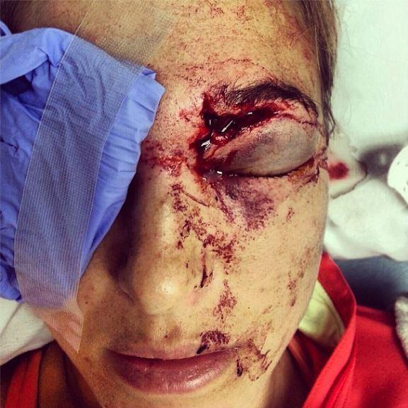 Aşa arată o femeie cunoscută de întreaga lume după ce a fost lovită de soţ. "Încă îl mai iubesc" 189125