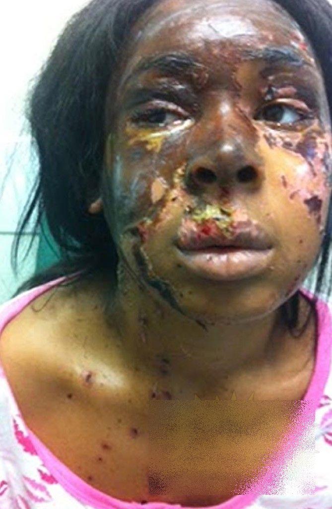 Mai avea 5 minute şi ajungea acasă. Ce i s-a întâmplat acestei tinere e îngrozitor. Acum nu se mai poate uita în oglindă 191674