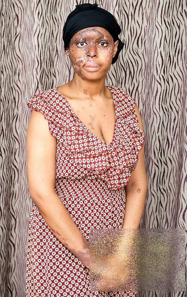 Mai avea 5 minute şi ajungea acasă. Ce i s-a întâmplat acestei tinere e îngrozitor. Acum nu se mai poate uita în oglindă 191675