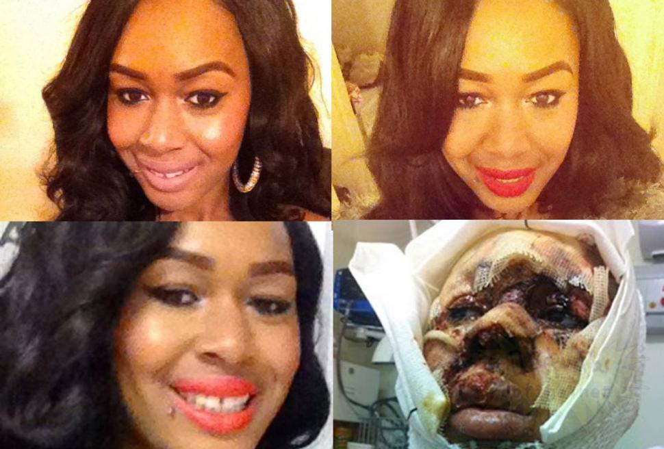 Mai avea 5 minute şi ajungea acasă. Ce i s-a întâmplat acestei tinere e îngrozitor. Acum nu se mai poate uita în oglindă 191676