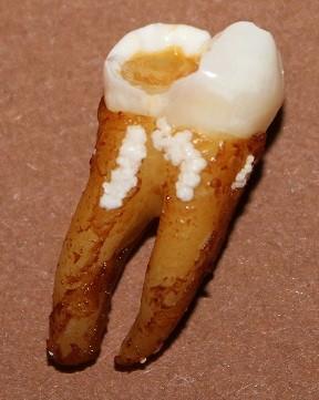 Cum ajung să arate dinţii tăi atunci când bei SUCURI ACIDULATE. Rezultatul unui EXPERIMENT care te va îngrozi 203187