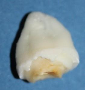 Cum ajung să arate dinţii tăi atunci când bei SUCURI ACIDULATE. Rezultatul unui EXPERIMENT care te va îngrozi 203189