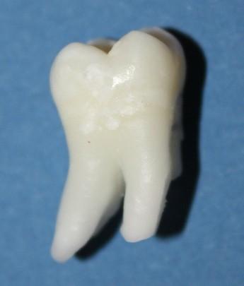 Cum ajung să arate dinţii tăi atunci când bei SUCURI ACIDULATE. Rezultatul unui EXPERIMENT care te va îngrozi 203190