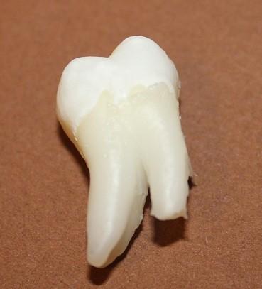 Cum ajung să arate dinţii tăi atunci când bei SUCURI ACIDULATE. Rezultatul unui EXPERIMENT care te va îngrozi 203191