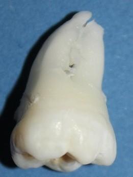 Cum ajung să arate dinţii tăi atunci când bei SUCURI ACIDULATE. Rezultatul unui EXPERIMENT care te va îngrozi 203192