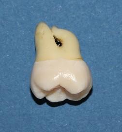 Cum ajung să arate dinţii tăi atunci când bei SUCURI ACIDULATE. Rezultatul unui EXPERIMENT care te va îngrozi 203194