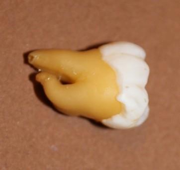 Cum ajung să arate dinţii tăi atunci când bei SUCURI ACIDULATE. Rezultatul unui EXPERIMENT care te va îngrozi 203195