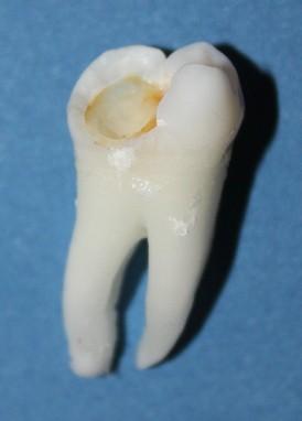 Cum ajung să arate dinţii tăi atunci când bei SUCURI ACIDULATE. Rezultatul unui EXPERIMENT care te va îngrozi 203196