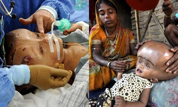 Şansă la o viaţă normală: Fetiţa cu capul &quot;de extraterestru&quot; a fost operată cu succes, în India