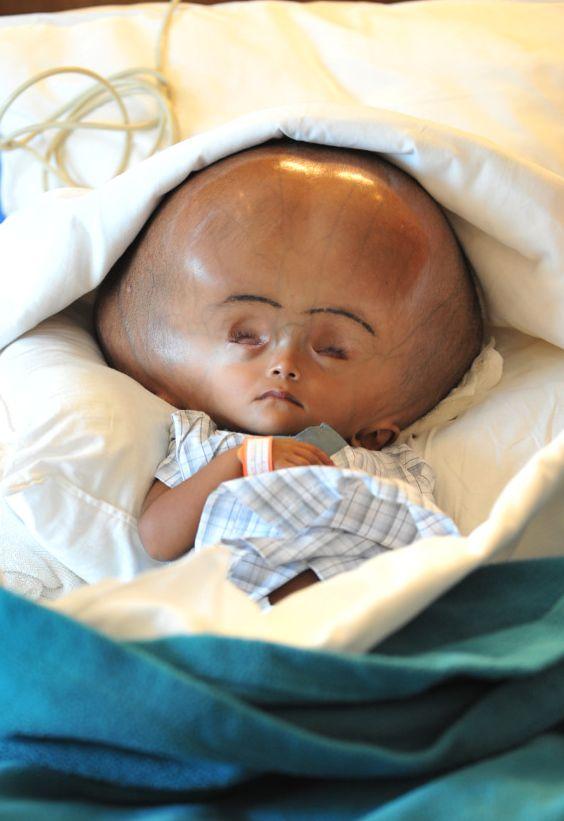 Şansă la o viaţă normală: Fetiţa cu capul "de extraterestru" a fost operată cu succes, în India 208076