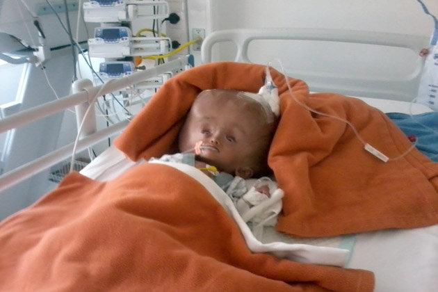 Şansă la o viaţă normală: Fetiţa cu capul "de extraterestru" a fost operată cu succes, în India 208077